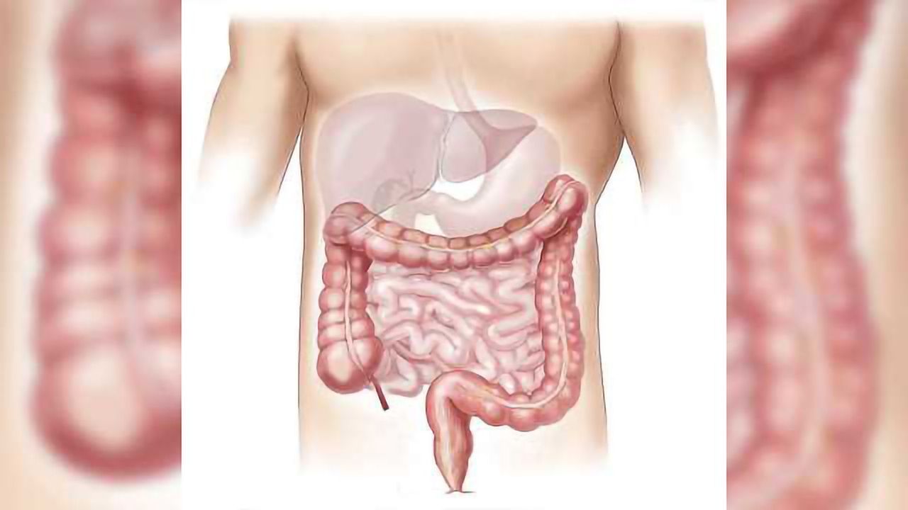 Marker May Help Target Treatments for Crohn’s Patients