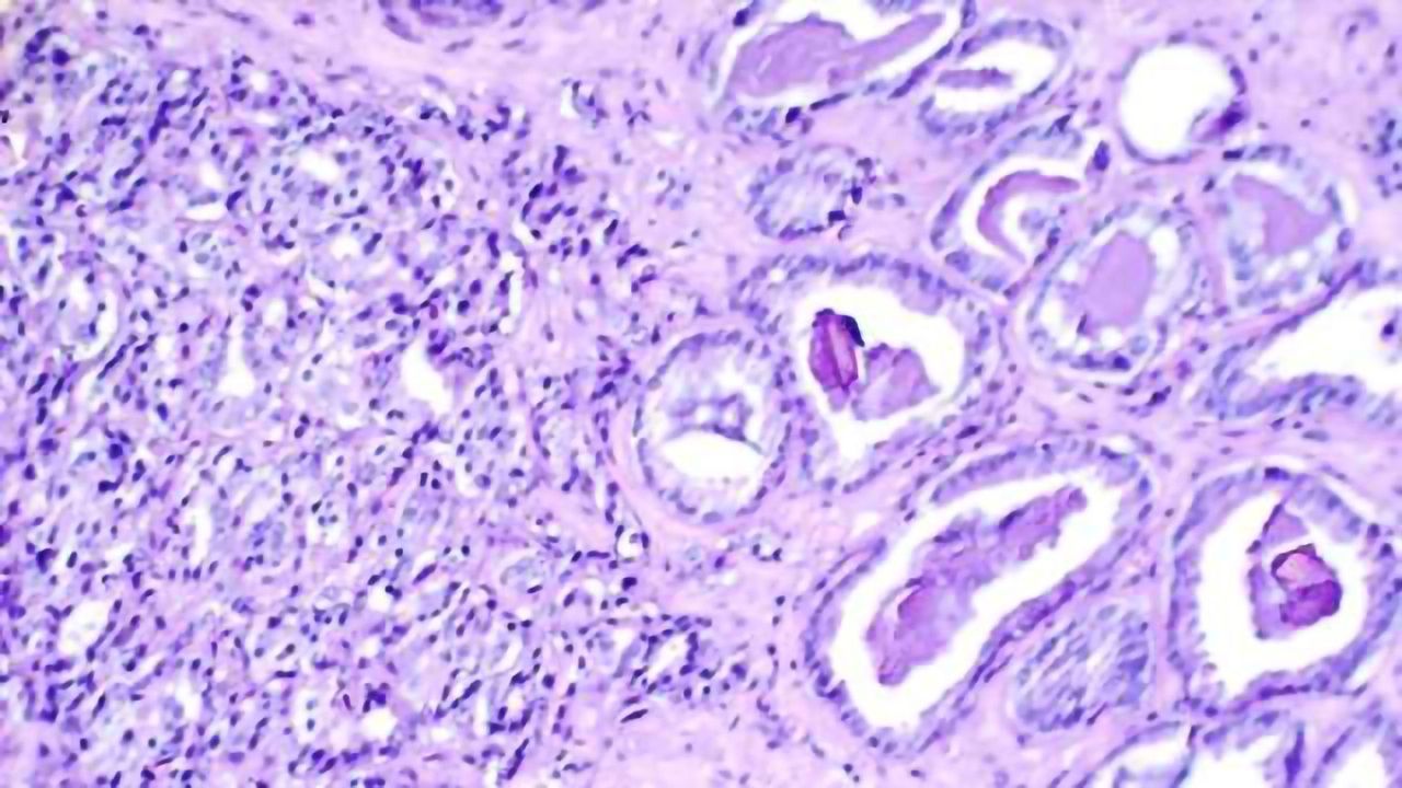 Treating the Prostate with Radiotherapy Improves Survival