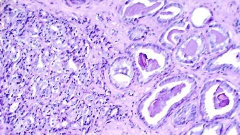 Treating the Prostate with Radiotherapy Improves Survival
