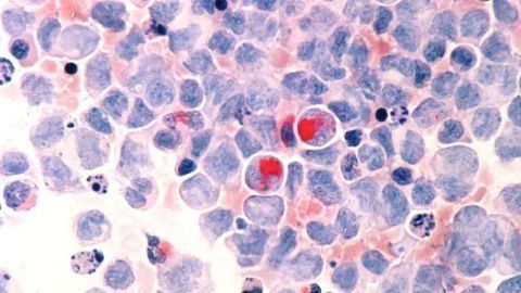 Drug Combo Destroys Chemo-resistant Blood Cancer