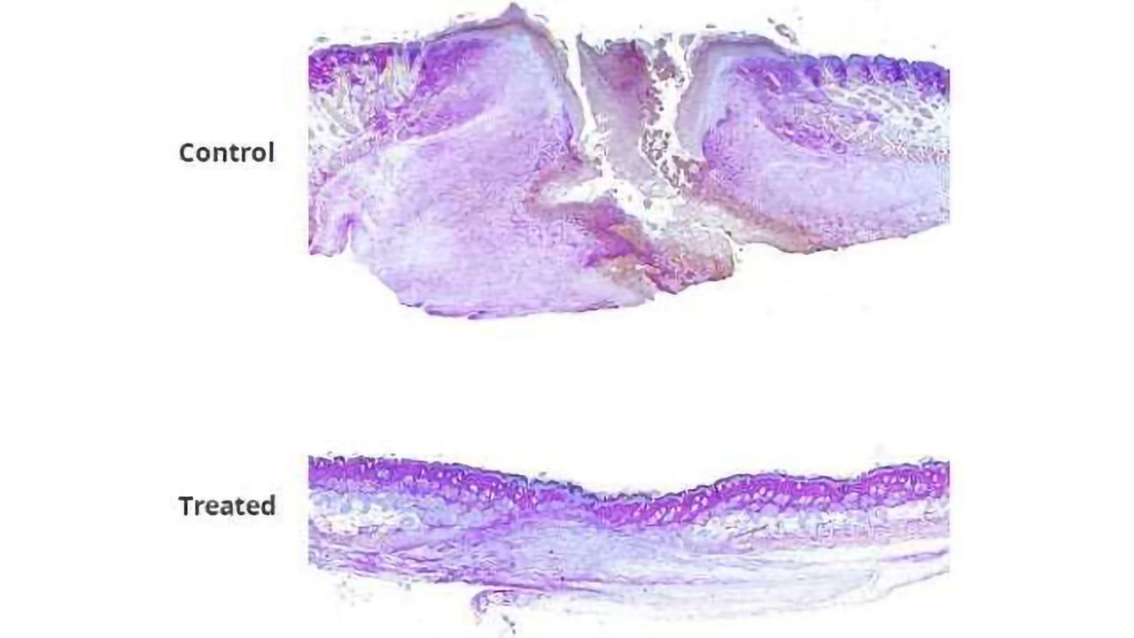 Healing Time Cut in Half with Drug–Gel Combo