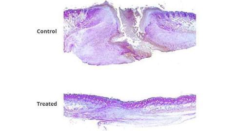 Healing Time Cut in Half with Drug–Gel Combo