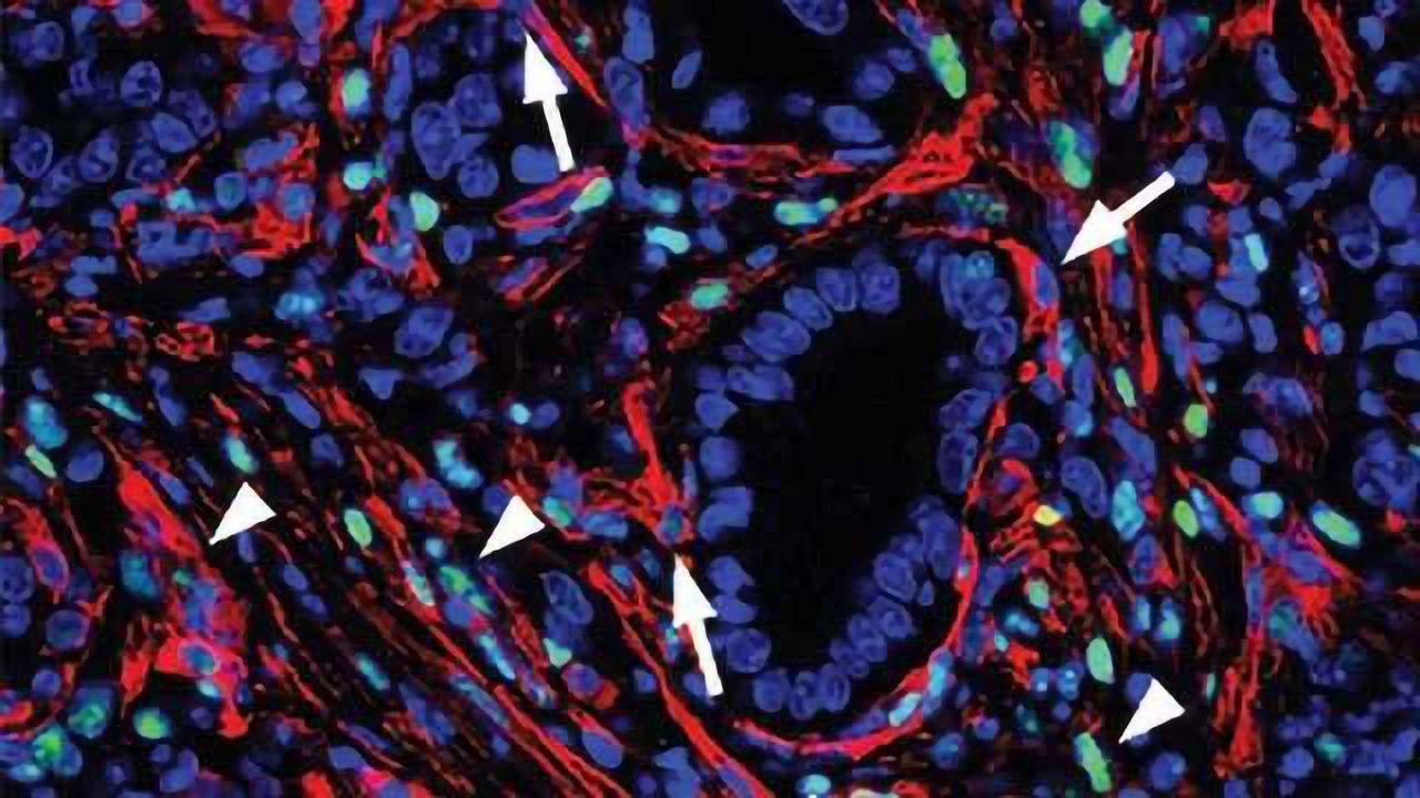 Turning Cells Against Pancreatic Cancer