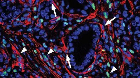 Turning Cells Against Pancreatic Cancer