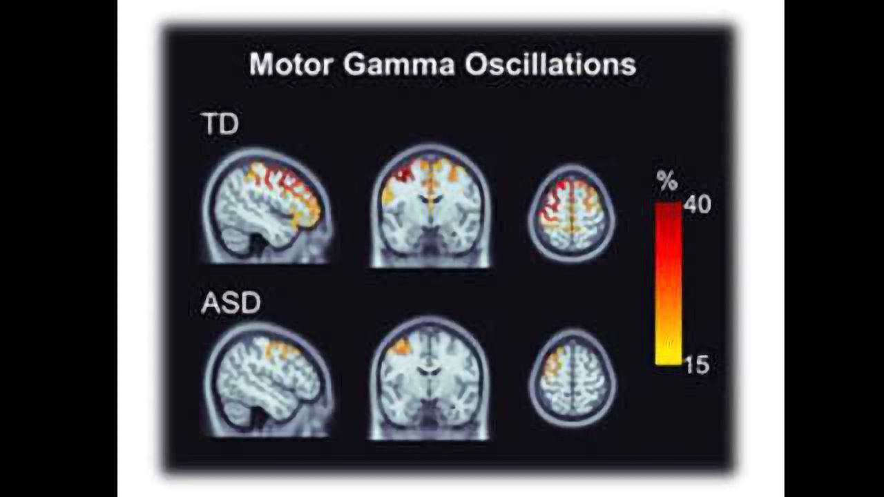 Brainwave Activity Alterations Shown in Autistic Children