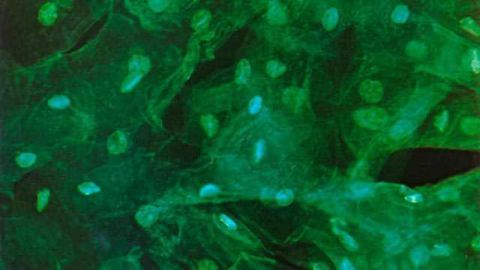 Weight Loss Surgery for Obese Women Prevents Womb Cancer
