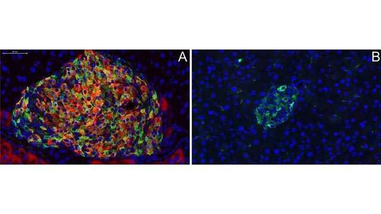 A New Way to Treat Type 1 and Type 2 Diabetes?