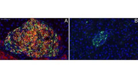 A New Way to Treat Type 1 and Type 2 Diabetes?