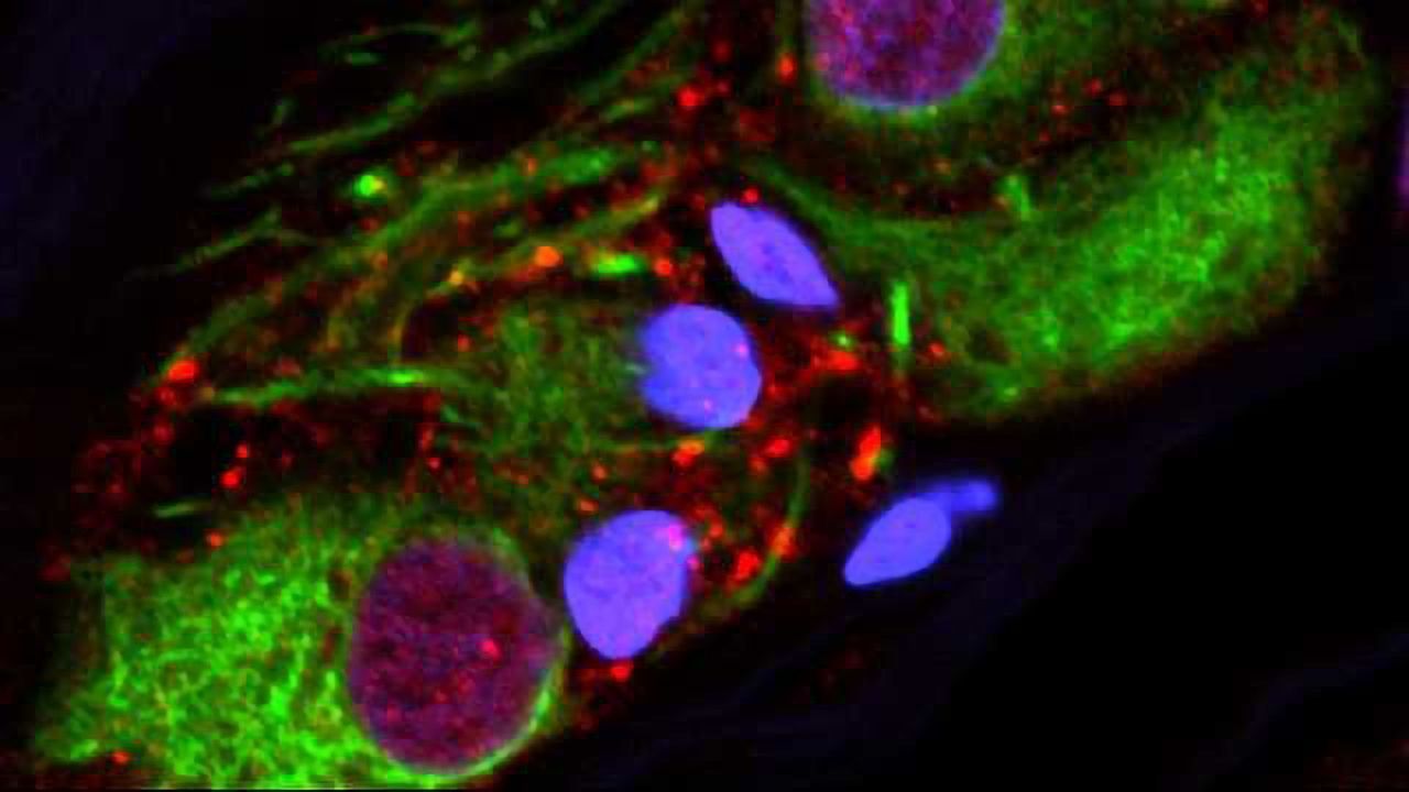 Appendix Removal Lowers Parkinson's Disease Risk by up to 25%