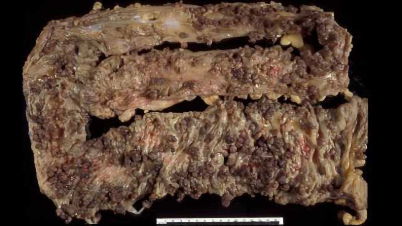 Could Gut Stem Cells Hold the Key to Preventing Bowel Cancer?