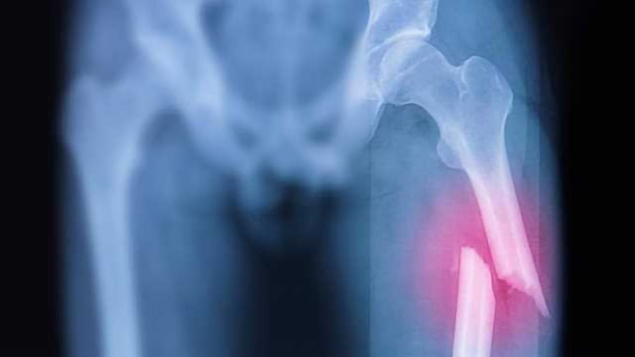 A Way to Fix Bone Fractures Faster?