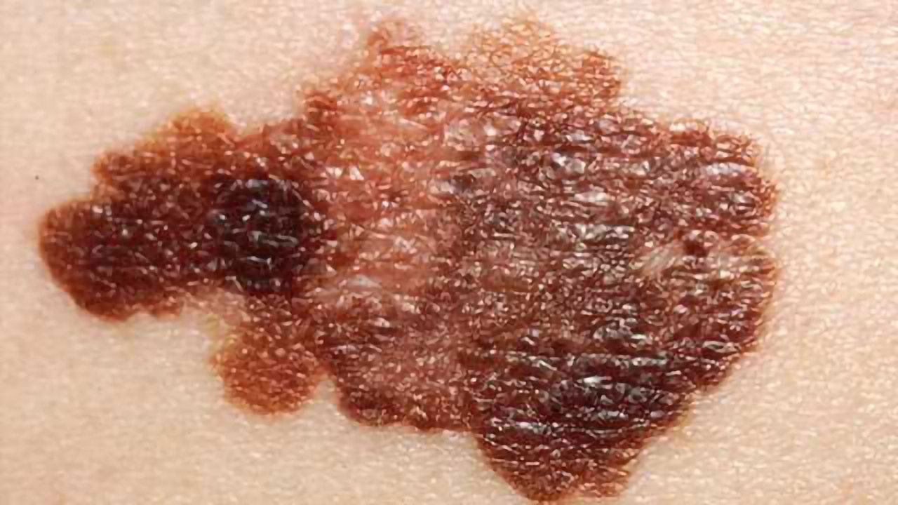 How Melanoma Evades Targeted Therapies