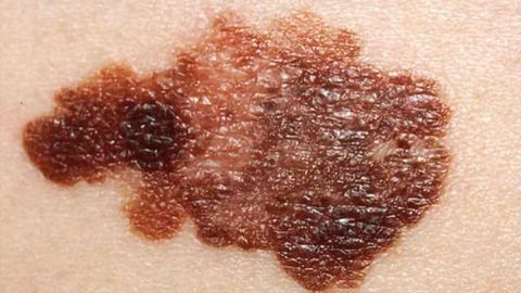How Melanoma Evades Targeted Therapies