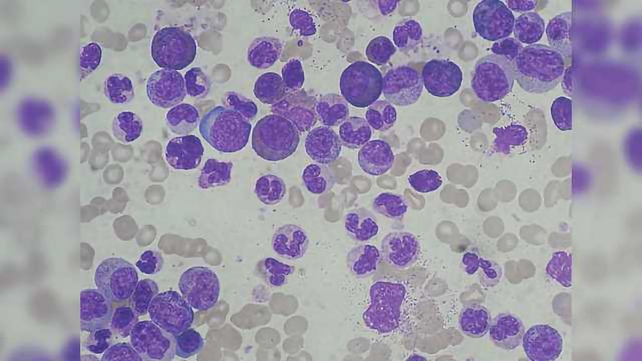 Chemo-Immunotherapy Combo Effective for Leukemia in Phase II