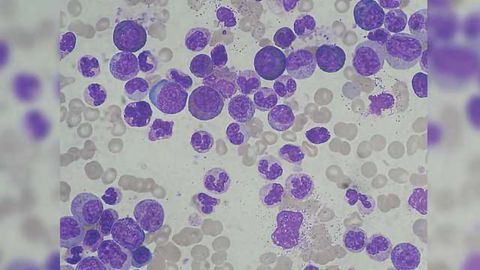 Chemo-Immunotherapy Combo Effective for Leukemia in Phase II