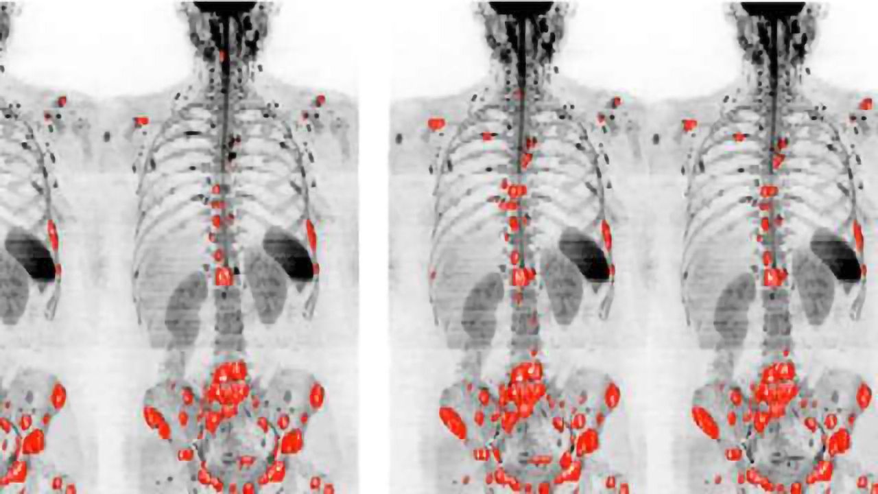 High-Tech Scans Should be Used More in Prostate Cancer