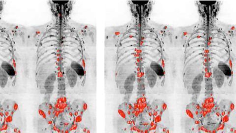 High-Tech Scans Should be Used More in Prostate Cancer