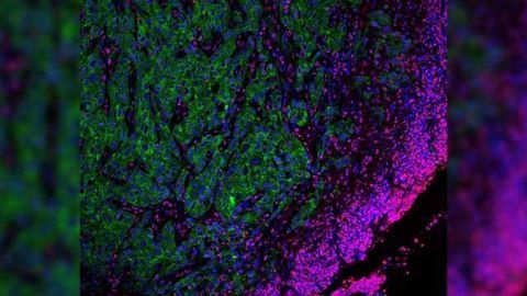 Epigenetic Treatments Could Trigger Aggressive Tumors