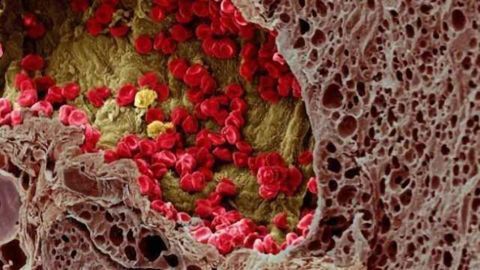 Cutting the Legs Off Cancer