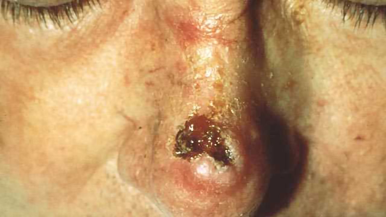 New Drug Target for Skin Cancer?