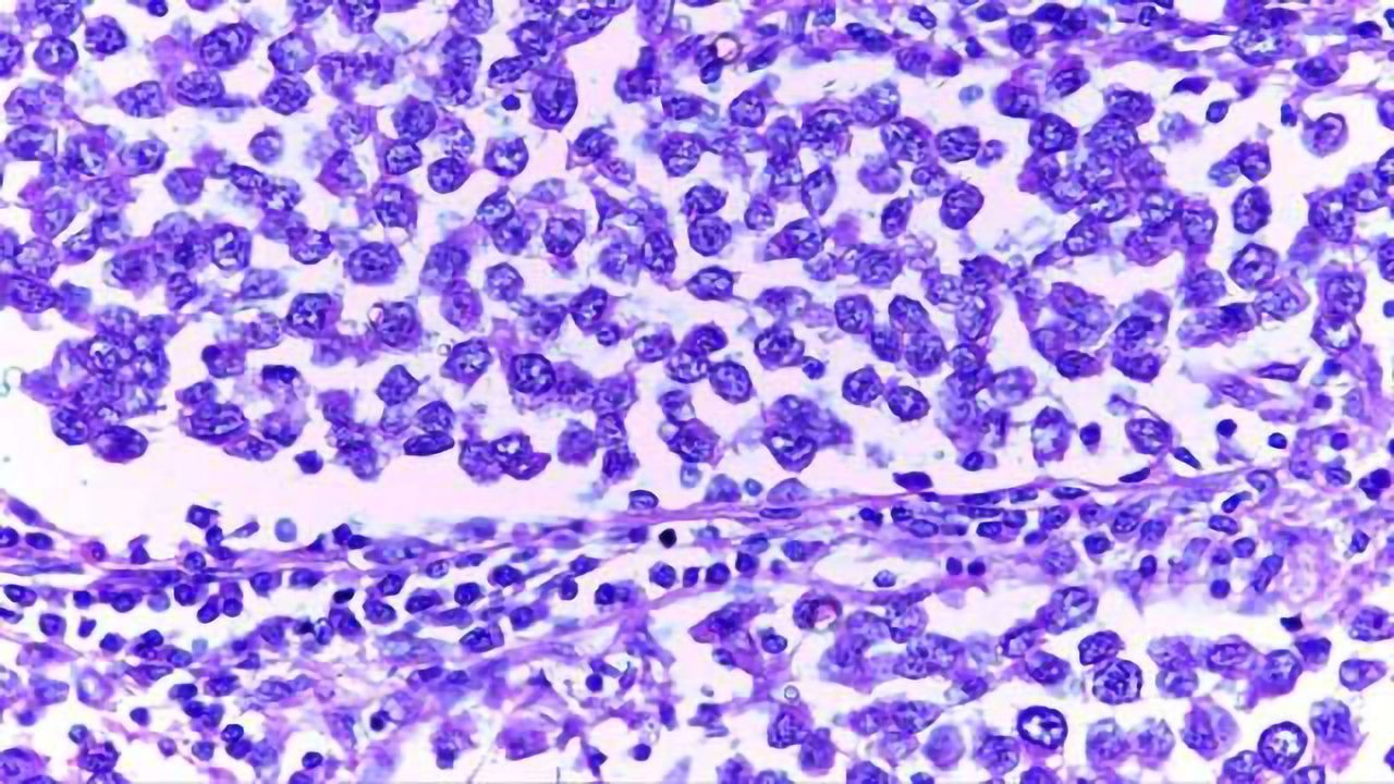 Why Testicular Cancer Runs in Families