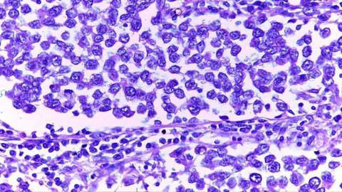 Why Testicular Cancer Runs in Families