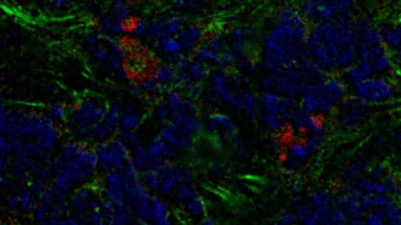 Breast Tumors Boost Their Growth by Recruiting Cells Formed in the Bone Marrow