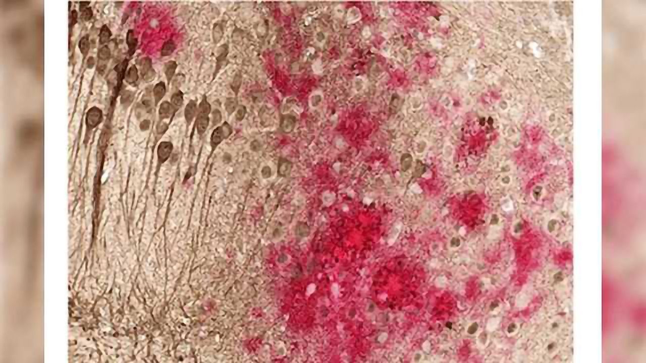 DNA Vaccine Reduces Amyloid Deposition and Tau Pathology in Mice