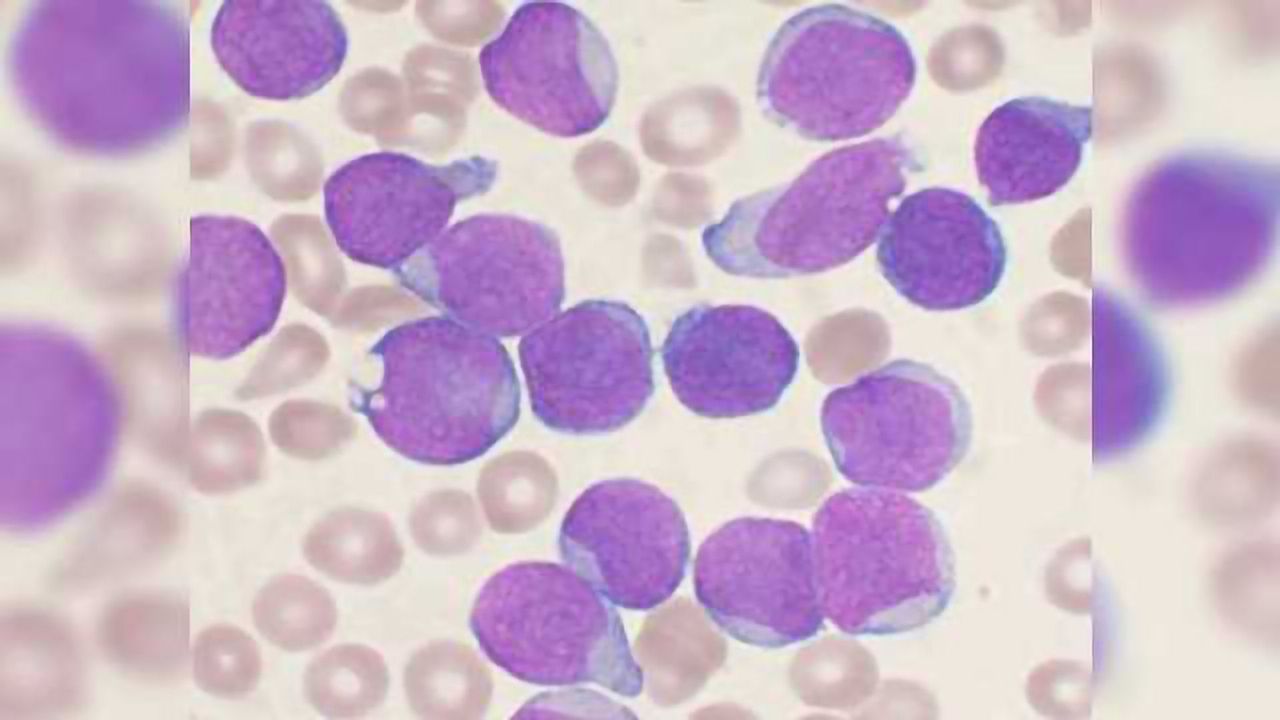 New Stem Cell Therapy to Strengthen Fight Against Leukemia