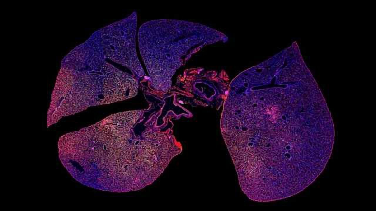 Simple Nanoparticle-based Urine Test Could Diagnose Bacterial Pneumonia