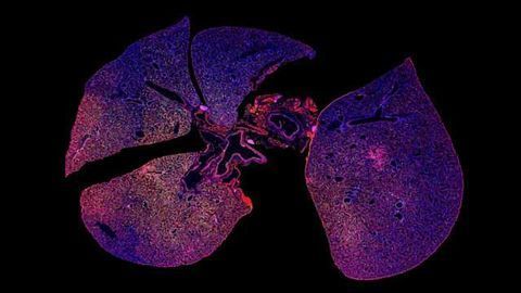 Simple Nanoparticle-based Urine Test Could Diagnose Bacterial Pneumonia