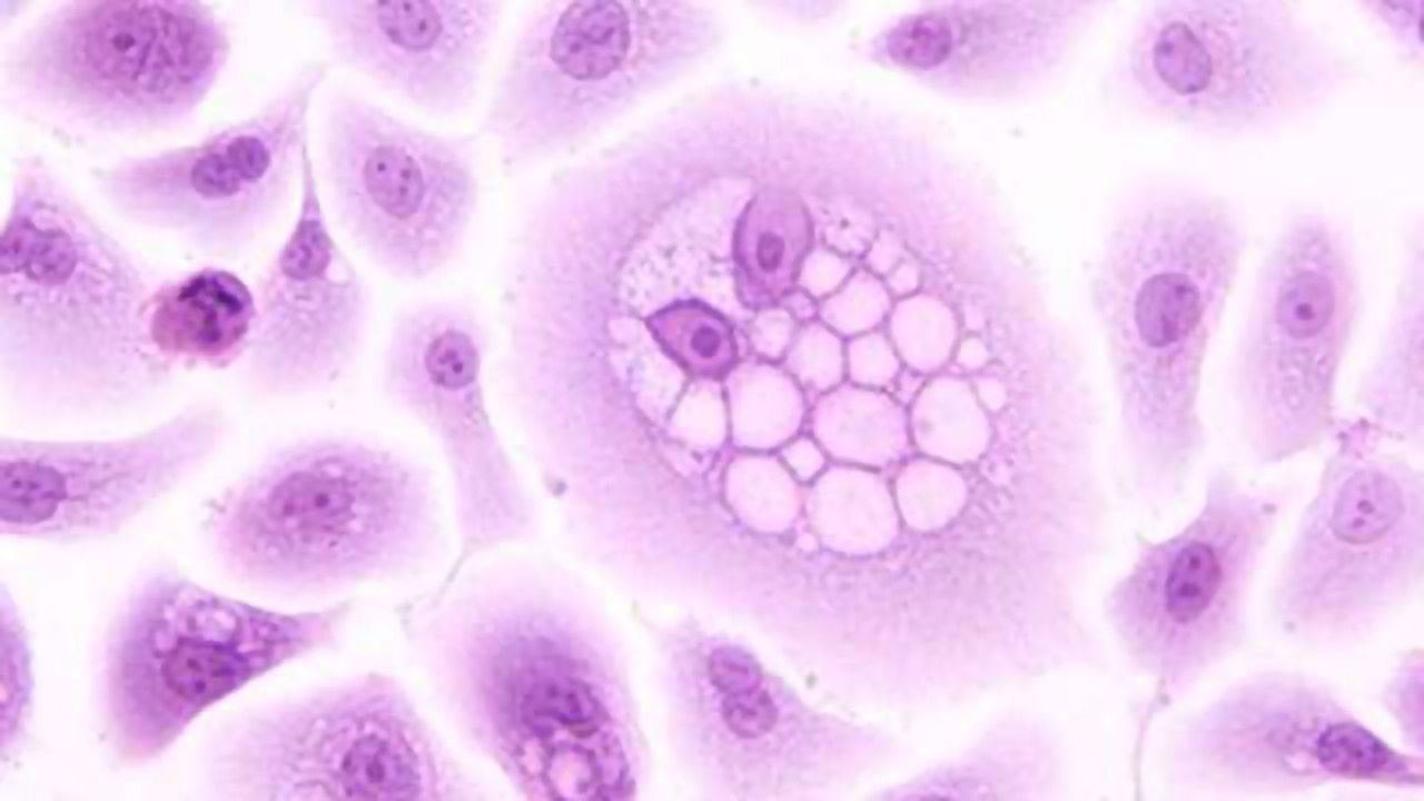 Cancer Drug May Help Treat HPV Infections