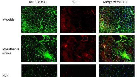 Cutting Off Autoimmune Disease at the Checkpoint
