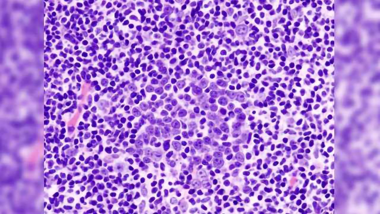 CAR-T Therapy 2-year Survival Rates for People with B-Cell Lymphoma
