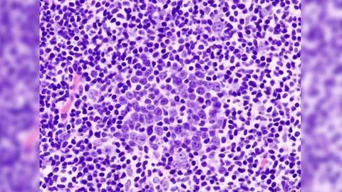 CAR-T Therapy 2-year Survival Rates for People with B-Cell Lymphoma