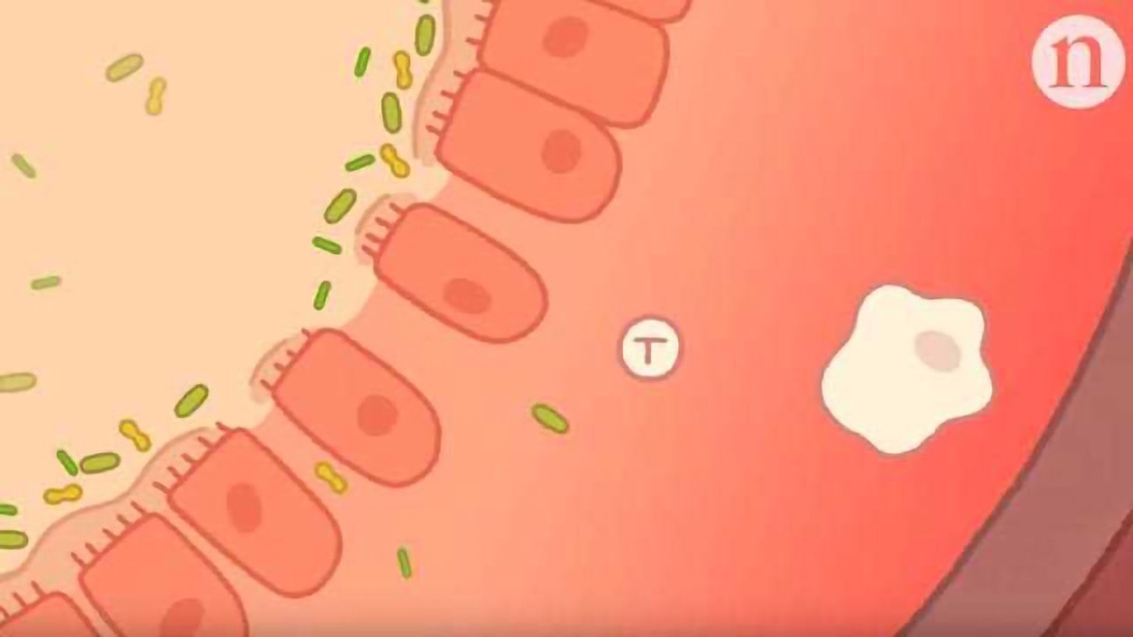 Ulcerative Colitis: Fresh Approaches to Taming Inflammation
