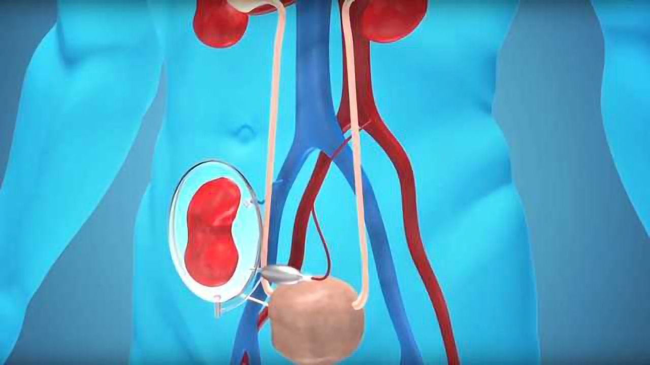 Kidney Encapsulation - Immunosuppression Filter