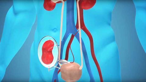 Kidney Encapsulation - Immunosuppression Filter