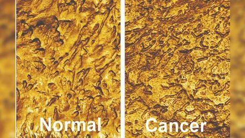 Improved Non-invasive Method for Detecting Bladder Cancer