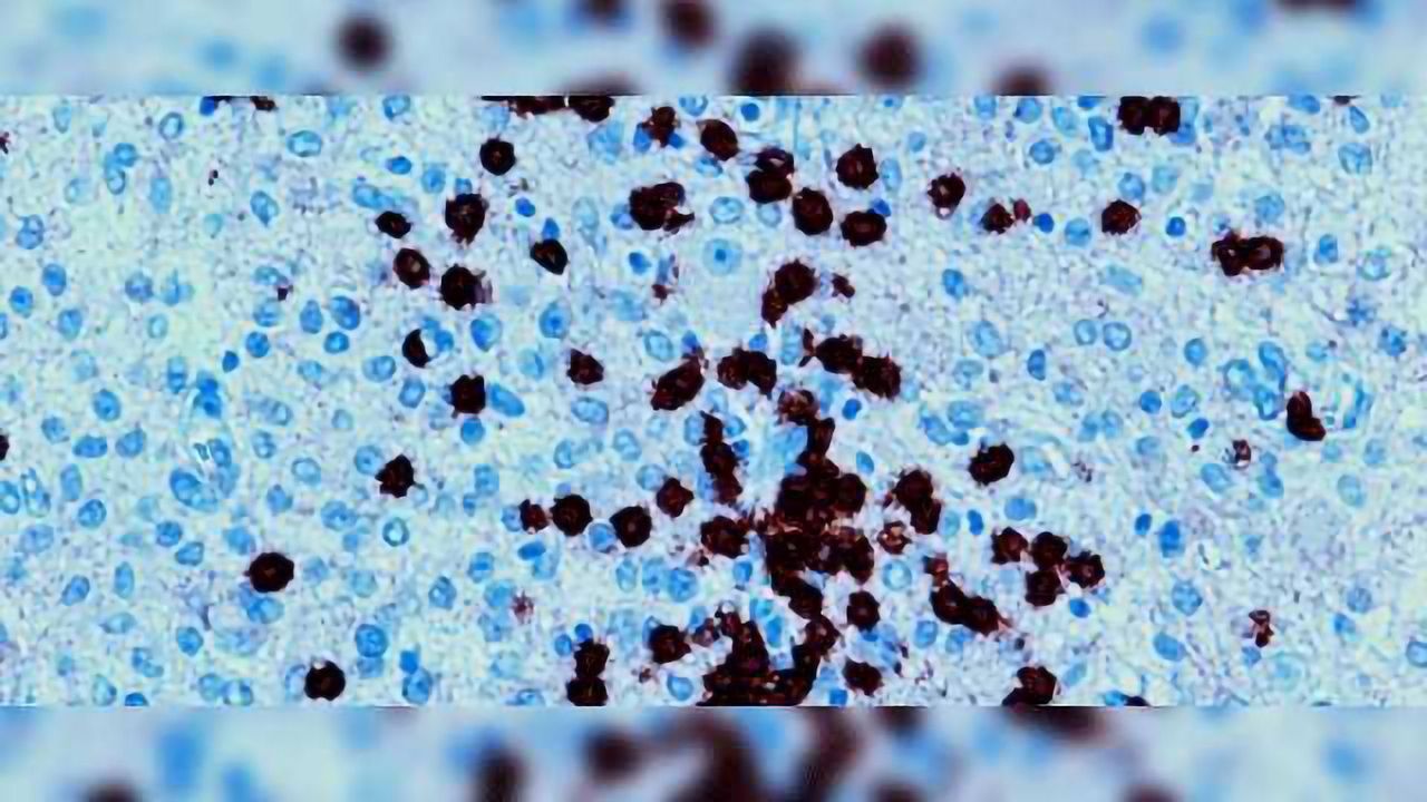 Immunotherapy Opportunities Lie in Glioma Molecular Landscape