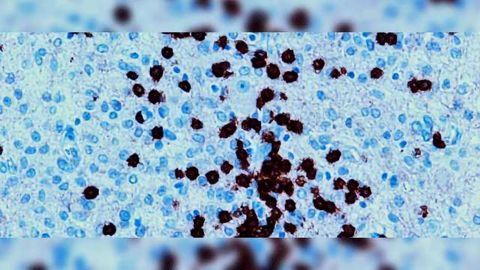 Immunotherapy Opportunities Lie in Glioma Molecular Landscape