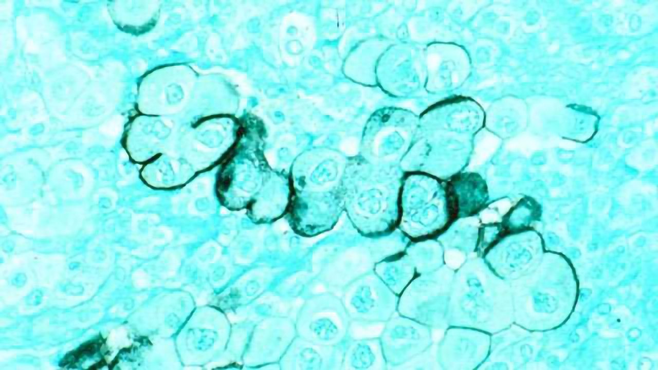 Repurposing Breast Cancer Drug to Help Treat Pancreatic Cancer