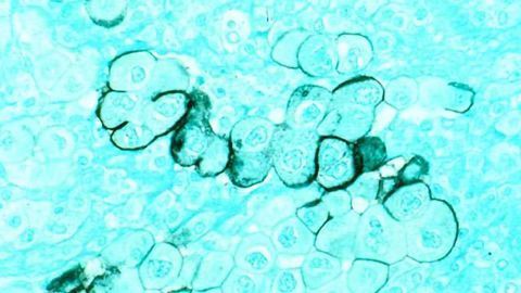Repurposing Breast Cancer Drug to Help Treat Pancreatic Cancer