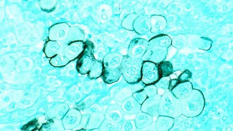 Repurposing Breast Cancer Drug to Help Treat Pancreatic Cancer content piece image