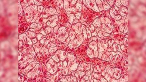 Loss of Tight Junction Protein Promotes Development of Precancerous Cells