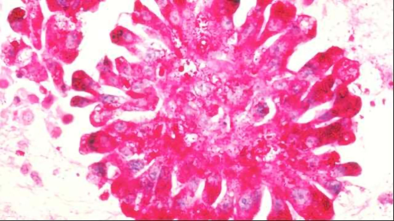 Drug Seeks Out Receptors in Sarcoma Cells, Shrinks Tumors