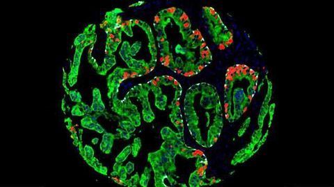 Prostate Cancer: Predicting the Course of Disease