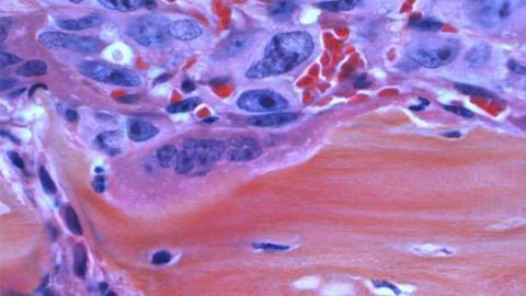 Drug Improves Outcomes & Survival Rates in Patients with Bone Marrow Cancer