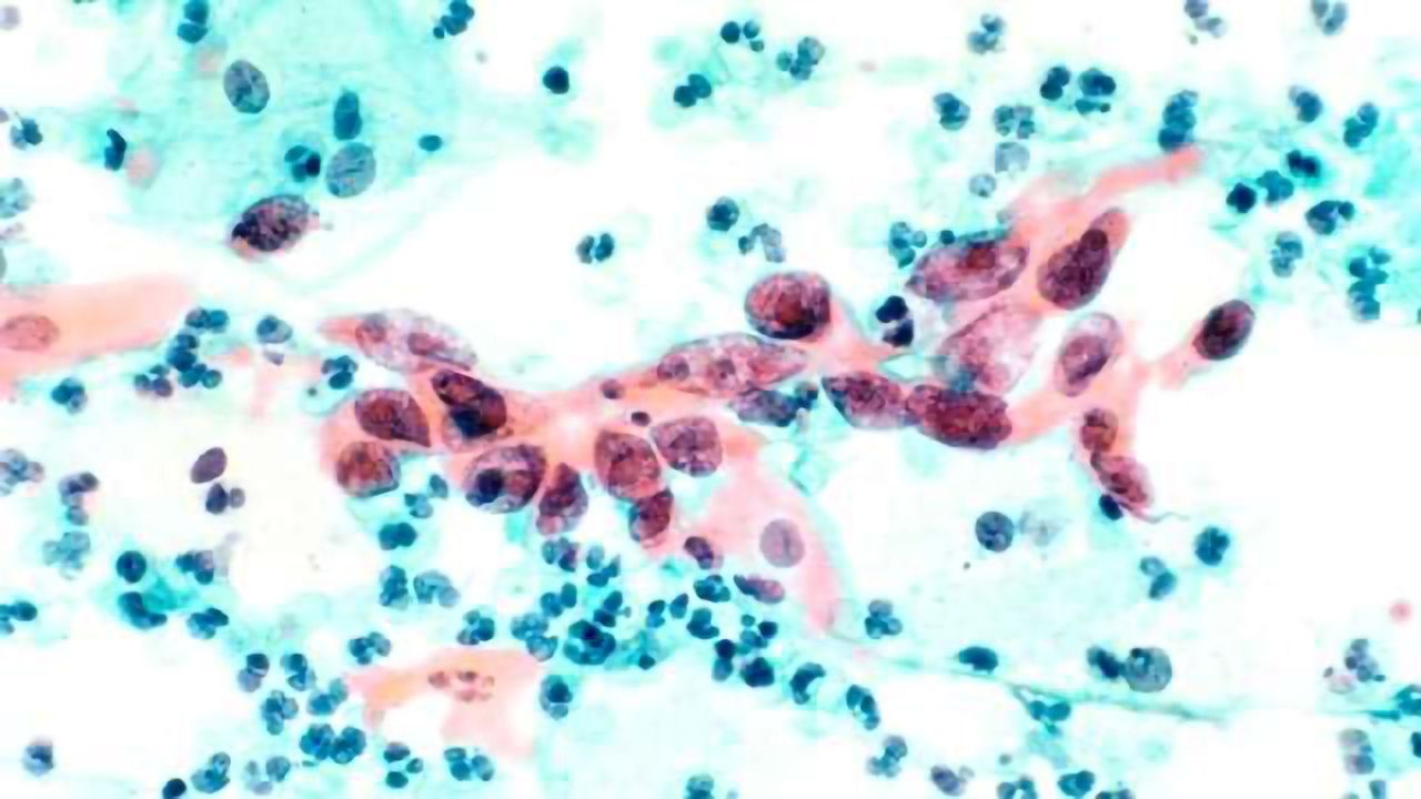 Cervical Cancer Test Has 100% Detection Rate