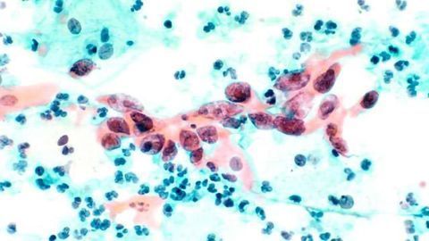 Cervical Cancer Test Has 100% Detection Rate
